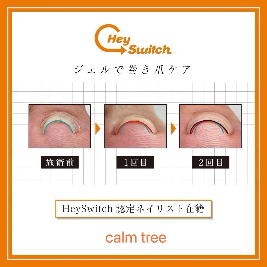 巻き爪でお悩みの方へ